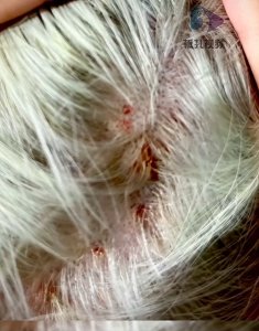 ​男子花5000元漂染头发致头皮二度烧伤，“事发后发型师消失了，助理也称自己失