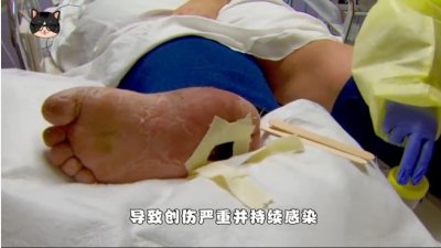 ​什么是“蛆虫疗法”？看完涨知识了